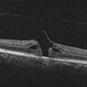 Stage 2 Macular Hole Stage 2 Macular Hole